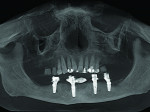 Panoramic view from CBCT scan at 6 months after grafting demonstrating complete osseous fill and blending of the graft with the adjacent native bone.