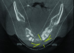 CBCT axial view.