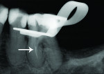 Radiographic example of a separated endodontic rotary NiTi file.
