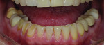 Case 1 presentation. The patient exhibited severe wear on her anterior and right mandibular arch due to a restricted envelope of function and a decreased vertical dimension. She requested a conservative restorative plan that minimized reduction of tooth structure.