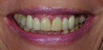 Case 2 presentation. Patient disliked the discolored bonding on her central incisors and the unesthetic appearance of her missing lateral incisors.