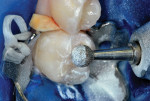 Figure 7 Occlusal surface trimmed and sculpted.