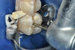 Figure 3 Outline form cut with cylindrical diamond bur. Wooden wedge in place during tooth preparation.