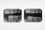 Figure 10 Preoperative (left) and 6-month postoperative (right) bitewing films.