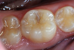 Figure 11 Case 2: First molar with occlusal caries lesion.