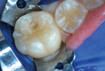 Figure 12 After initial outline form revealed caries extent, carious substance completely
removed.