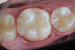 Figure 16 Following occlusal surface sculpting and self-etch adhesive application, completed occlusal repair is shown.