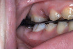 Figure 17 Occlusal contacts evaluated with articulating paper. Note mesial surface caries lesion of maxillary molar.