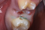 Figure 18 Retraction cord in place, tooth preparation completed.
