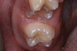 Figure 19 Mesial restoration, 4 months after treatment.