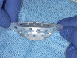 Figure 1 A tray is selected for the preliminary impression (TempTray™ [Clinician’s Choice] shown here).