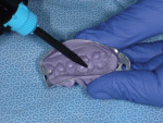 Figure 5 Provisional material will then be injected into the preliminary impression in the area of the prepared tooth.