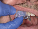 Figure 6 The tray with provisional material is placed back into the patient’s mouth in the area of preparation.