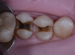 Figure 2 Preparations following removal of the amalgam.