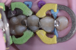 Figure 7 A buccal wall increment of the packable restorative in an A1 body shade was placed.