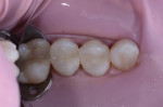 Figure 10 The restorations are shown following completion of contouring.