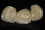 Figure 4 Lingual view of FPD. Note that veneering porcelain is not present at occlusal contact areas.