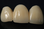Figure 3 Porcelain-fused-tozirconia FPD for teeth Nos. 7 through 9.