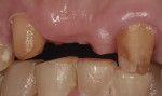 Figure 2 Preparation of teeth for veneered zirconia FPD.
