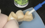 Figure 7 Application of MDP primer to intaglio surfaces of abutment crowns.