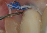 Figure 15 Removal of excess cement and retraction cord post-cure.