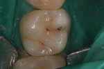 Figure 2 The same tooth shown under a rubber dam prior to decay removal and preparation.