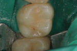 Figure 9 Tooth No. 3 shown immediately postoperatively with the rubber dam still in place.