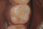 Figure 10 Tooth No. 3 shown after rubber dam removal with the finished restoration.