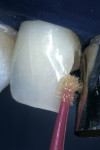Figure 2  A single-component self-etch adhesive was applied to the entire cavity surface and allowed to dwell for 10 seconds.