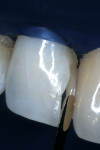 Figure 5  To disguise the silhouette of the cavity form, an artificial dentin core was developed with an opaque AO2-shaded hybrid composite resin.