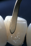 Figure 6  A translucent-shaded hybrid composite resin was applied, sculpted, and smoothed to the lingual aspect with a curved instrument and light cured for 40 seconds.
