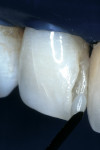 Figure 7  The first artificial enamel layer, an A-1 shaded hybrid composite resin was applied to the facial aspect and contoured with a longbladed composite instrument.