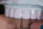 Fig 15. Thin double-sided disk is used to balance incisal embrasures.