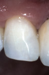 Figure 10  The postoperative result achieved with the use of this direct composite resin reflects the harmonious integration of natural tooth structure with restorative material and color.
