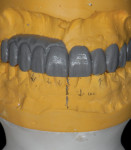 Fig 12. A gingival component was added to the wax-up to reconstruct the negative bony architecture and evaluate facial support.