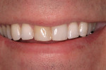 Figure 1  The preoperative smile showing the discolored right central incisor.