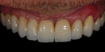Fig 21 through Fig 25. The final restoration is inserted and cemented and found acceptable by the patient and dental team.