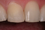 Figure 4  Preparation of the right central incisor.