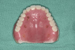 Figure 14 Maxillary denture with fiduciary
markers.