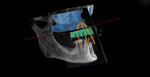 Figure 16 Virtual maxillary treatment plan (sagittal view).