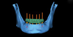 Figure 17 Virtual mandibular treatment plan with six planned implants.