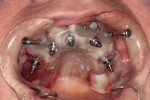 Figure 19 Maxillary surgical guide with pin fixation.