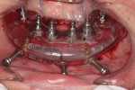 Figure 24 Mandibular implant placement completed.