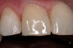 Figure 9  Appearance of the tooth after placement of hybrid.