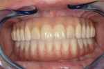 Figure 30 Final maxillary and mandibular prostheses in place.