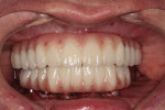 Figure 28 Completed maxillary and mandibular provisional bridges in occlusion immediately
postoperative.