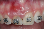 Figure 1 Initial clinical assessment of compromised central incisors.