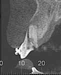 Figure 2 Tomographic examination of the maxillary right central incisor showing the root fracture without buccal bone plate.