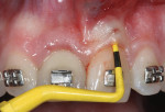 Figure 4 Clinical evaluation of the left central incisor 6 months after the first procedure.