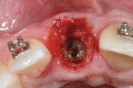 Figure 3 Reconstruction of the buccal bone plate using bone graft harvested from the right maxillary tuberosity, after implant placement
and construction of the immediate provisional crown.